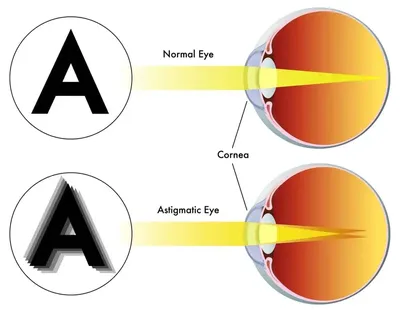 Symptoms of Astigmatism - Heffington's