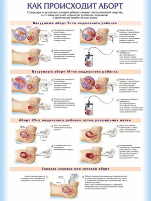 Аборт, виды абортов, влияние на организм женщины.