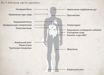 Человек-Шрек: у меня резко выросли нос или уши - что вы знаете об  акромегалии | О здоровье: с медицинского на русский | Дзен