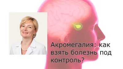 Акромегалия: симптомы, причины, диагноз и лечение