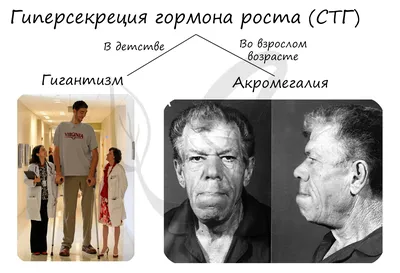 Акромегалия - современные подходы к лечению акромегалии: фокус на ком