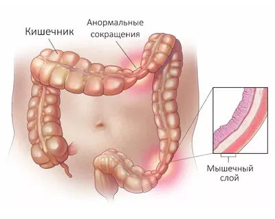 Классификация кишечных стом и осложнения