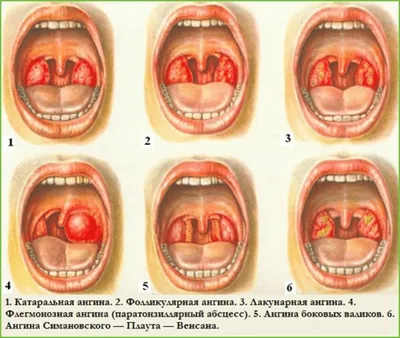 AnnaMama - Про ангину Воспаление небных миндалин и слизистой глотки:  тонзиллит (ангина), фарингит-основная причина боли в горле. Возбудители  ангины-бактерии, вирусы, грибы и др. 1️. Наиболее частые  возбудители-вирусы: антибиотики не нужны проходит ...