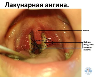 Лечение ангины у детей