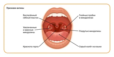 Ангина - ЛОР в Самаре - врач Лунёв Андрей Владимирович
