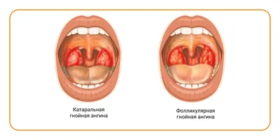 Герпангина — Википедия