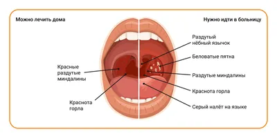 Ангина: истории из жизни, советы, новости, юмор и картинки — Все посты |  Пикабу