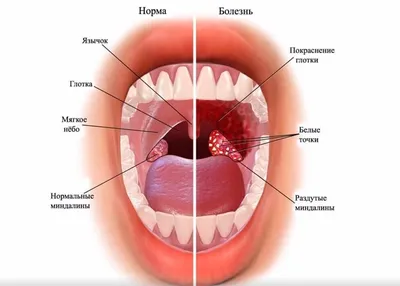 Гнойная ангина, чем лечить гнойную ангину, симптомы и признаки - блог  Furasol®