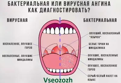 Ангина - лечение эффективно и надежно в Ростове-на-Дону