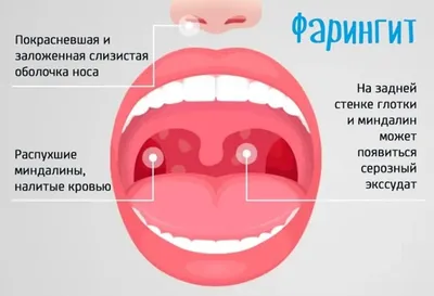 Стрептококковая ангина лечение, симптомы, инкубационный период, стрептококк  ангина — блог Furasol®