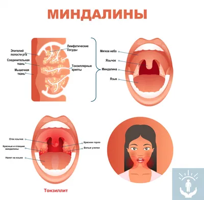 Герпетическая ангина у детей - признаки, причины, симптомы, лечение и  профилактика - iDoctor.kz