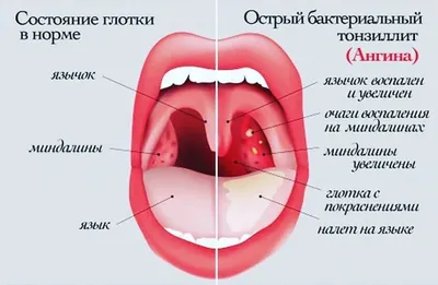 Внимание! Герпетическая ангина - Клиника детского здоровья \"Медведик\"