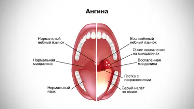 Ангина у взрослых - статьи от компании Еламед