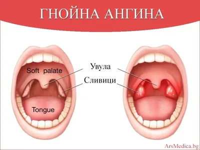 Простой рецепт от ангины! | Хозяйкины Хитрости | ВКонтакте