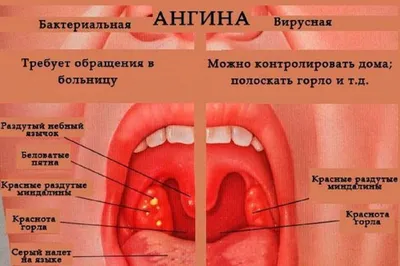 Медицинские центры КЦВ МИР - Ангина (острый тонзиллит) имеет инфекционную  природу и сопровождается появлением острого воспалительного процесса в  области небных миндалин. 👉 Развитие заболевания происходит при контакте со  стрептококком и стафилококком, а