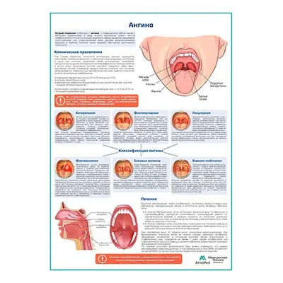 Ангина: причины, и симптомы, лечение, диагностика и профилактика ангины