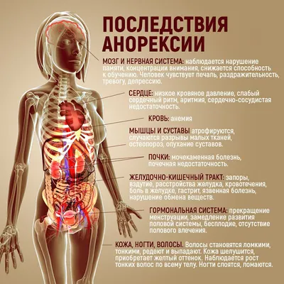 Информативный Плакат Расстройства Пищевого Поведения Анорексии — стоковая  векторная графика и другие изображения на тему Нервная анорексия - iStock