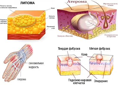 Современные методы удаление атером