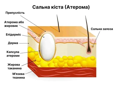 Удаление атеромы в клинике инновационных медицинских технологий «Градиент»  в Москве