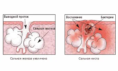 Атерома – симптомы, причины, лечение и профилактика заболевания у взрослых  | «Будь Здоров»