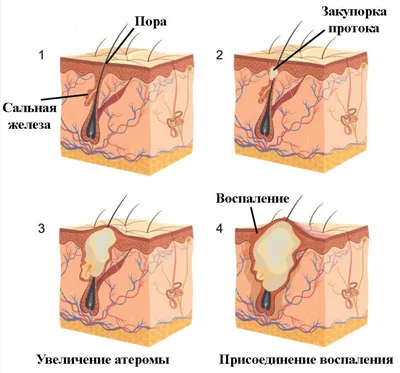 Атерома — удаляем без боли и рубцов | Evolutis Clinic | Дзен