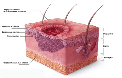 Как выглядит меланома, базалиома, базальноклеточный и плоскоклеточный рак —  симптомы рака кожи - 17 октября 2023 - chita.ru