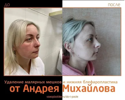 Векторный лифтинг препаратом Radiesse: цена процедуры в Москве | Инъекции  Радиесс для лица в клинике BeautyWay Clinic