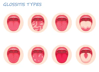 Глоссит языка у детей: симптомы и лечение - SHiFA
