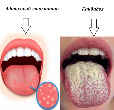 Симптомы болезни языка