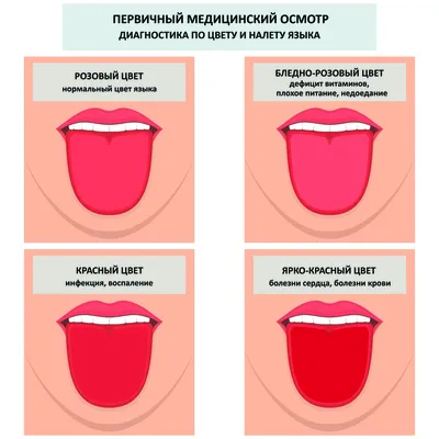 Стоматит 9 Фото, Чем Лечить На Языке, Десне- ЛюмиДент