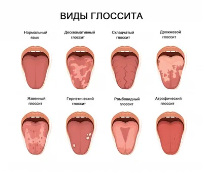 Глоссалгия – болезнь языка | Healthy Dent (Киев)