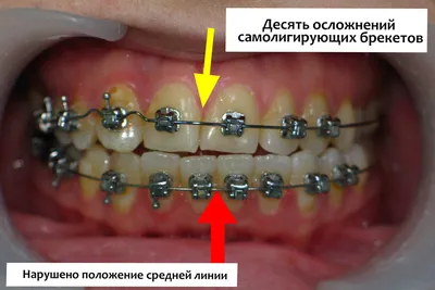 Лингвальные брекеты: цена установки невидимых брекет-систем | НоваДент