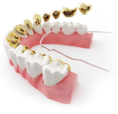 Какие брекеты выбрать для своего лечения: самолигирующие или  саморегулирующие?