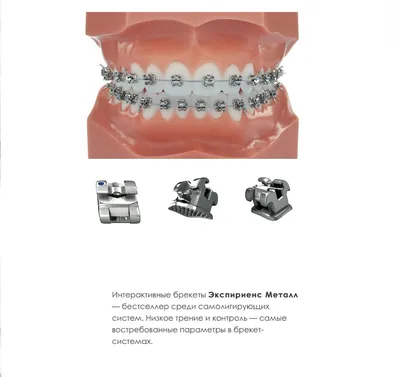 Сколько Носят Брекеты на Зубах