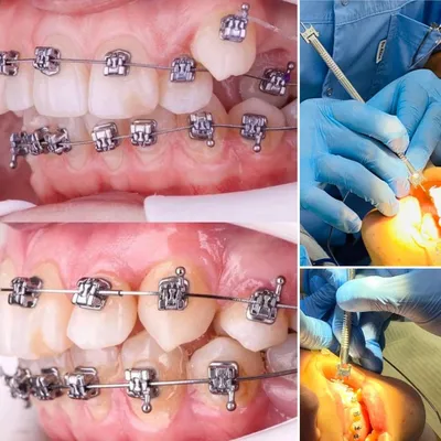 Установка брекетов в Минске по привлекательной цене