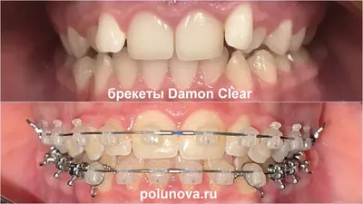 Металлические брекеты - Dental Practice