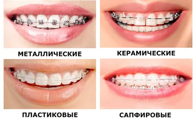 Металлические брекеты в Ярославле - стоматология Денталия