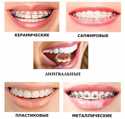 Установка самолигирующих брекетов в Минске, цены на безлигатурные  брекет-системы