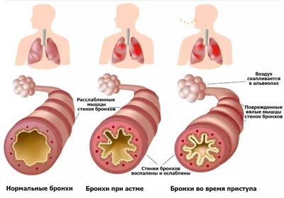 Бронхиальная астма картинки фотографии