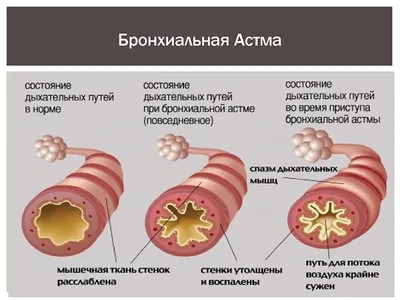 Как проявлется приступ бронхиальной астмы