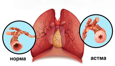 Бронхиальная астма | Клиника Добрый Доктор г. Красноярск