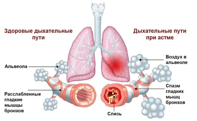 Бронхиальная астма