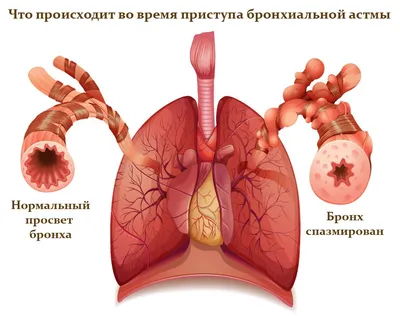 Бронхиальная астма у взрослых и детей, симптомы, лечение, диагностика и  рекомендации - ЛОРздрав