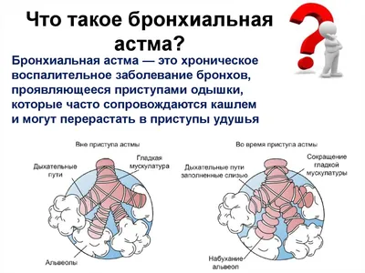 Бронхиальная астма - как обследоваться и лечиться? | Григорий Нефедов | Дзен