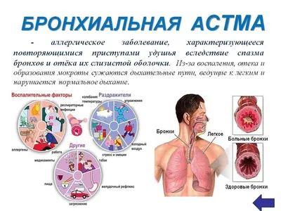 Как понять, что у тебя бронхиальная астма, к какому врачу обратиться