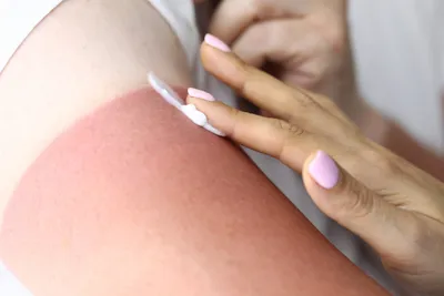 How Different Degrees of Burns Are Treated