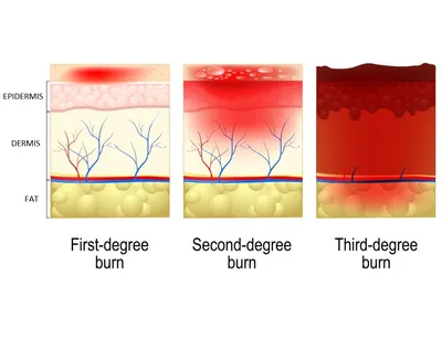 Burn Injury Lawyers in PA | Wieand Law Firm, LLC