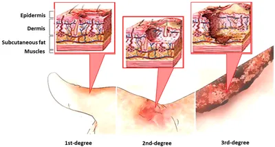 Second-degree burn: Causes, symptoms, and treatment