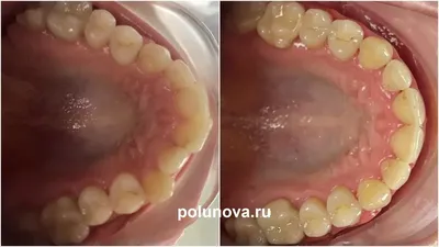 Верхняя челюсть: функция, проблемы и лечение - клиника Ортодонтика, Москва