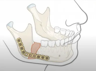 Зачем исправлять положение нижней челюсти? :: NORD DENTAL — сеть клиник  семейной стоматологии на севере Петербурга